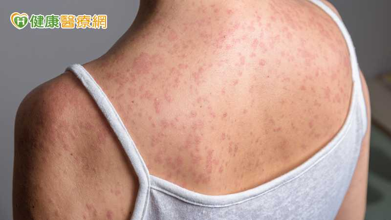 麻疹移入增2例！北部5旬女「無紅疹」併發腦炎住加護　疾管署這麼說's story cover image